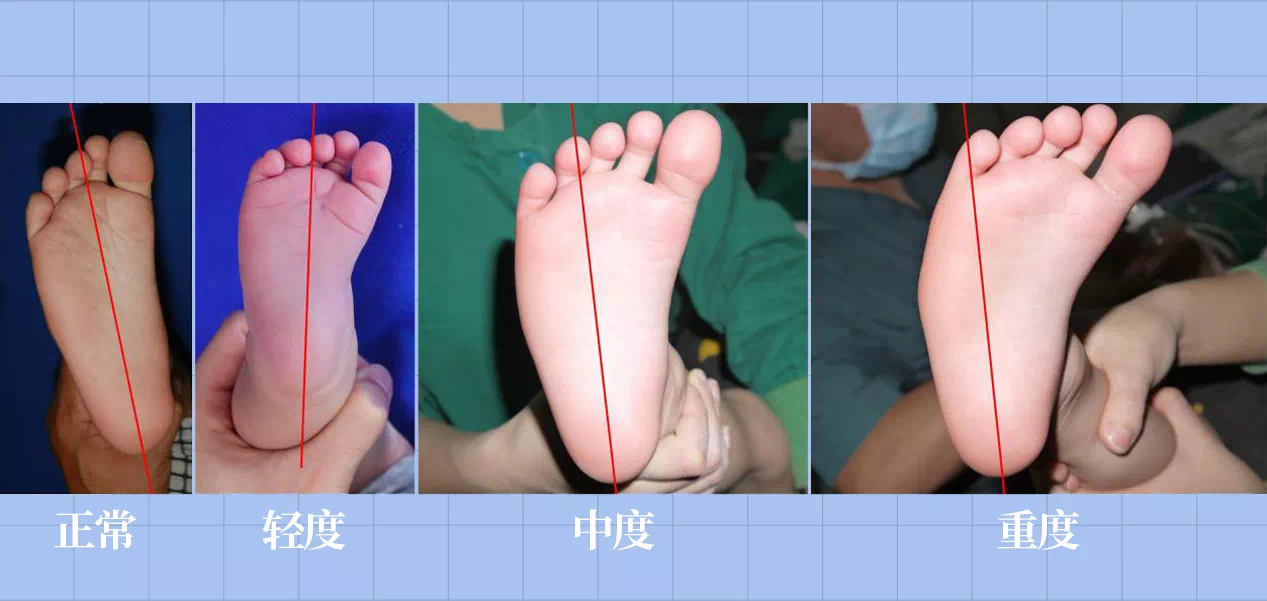 SPI足底压力分布计量